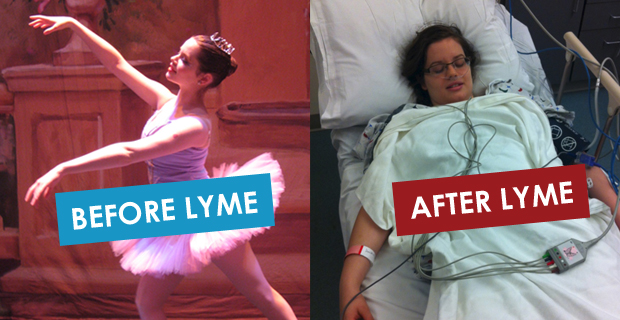 lyme_disease_before_after